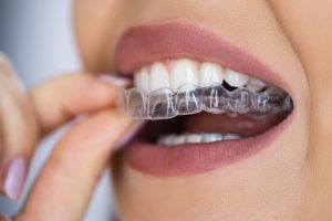 Invisalign Dentist for Danvers, Massachusetts